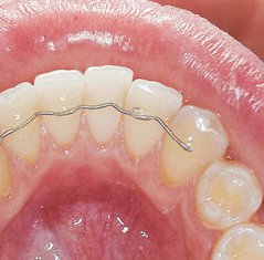 Retainer werden an der Innenseite der Zähne angebracht