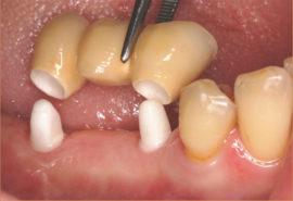 Das Zahnimplantat wird an Ihre individuelle Zahnfarbe angepasst.