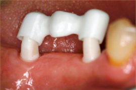Das Zahnimplantat wird auf den Implantat-gestützten Zahnersatz aufgesetzt.