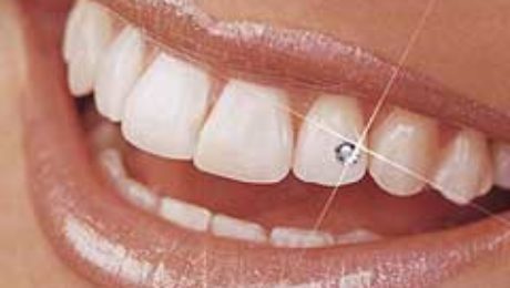 Ästhetischer Zahnschmuck auf den Zähnen einer Frau.