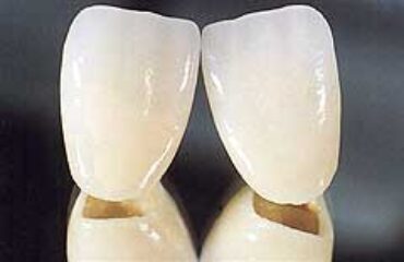 Durch die Galvanotechnik werden eine lebendige Zahnästhetik und perfekte Passgenauigkeit erreicht.