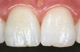Die Zahnästhetik dieser Schneidezähne ist durch eine organisch modifizierte Krone in unserer Praxis wieder vollständig hergestellt.