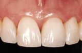 Zirkonoxid-Keramik ist eine effektive Behandlungsmethode nach einem Zahnverlust.