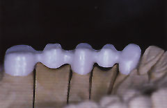 Ein Brückengerüst aus Zirkonoxid-Keramik bietet eine hohe Zahnästhetik, da kein Metallrand vorhanden ist.
