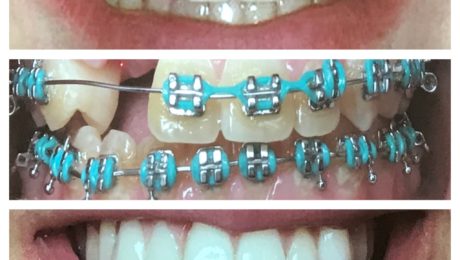 In unserer kieferorthopädischen Praxis ALL DENTE stellen wir Ihre Frontzahnästhetik nach Fahrradunfall wieder her.
