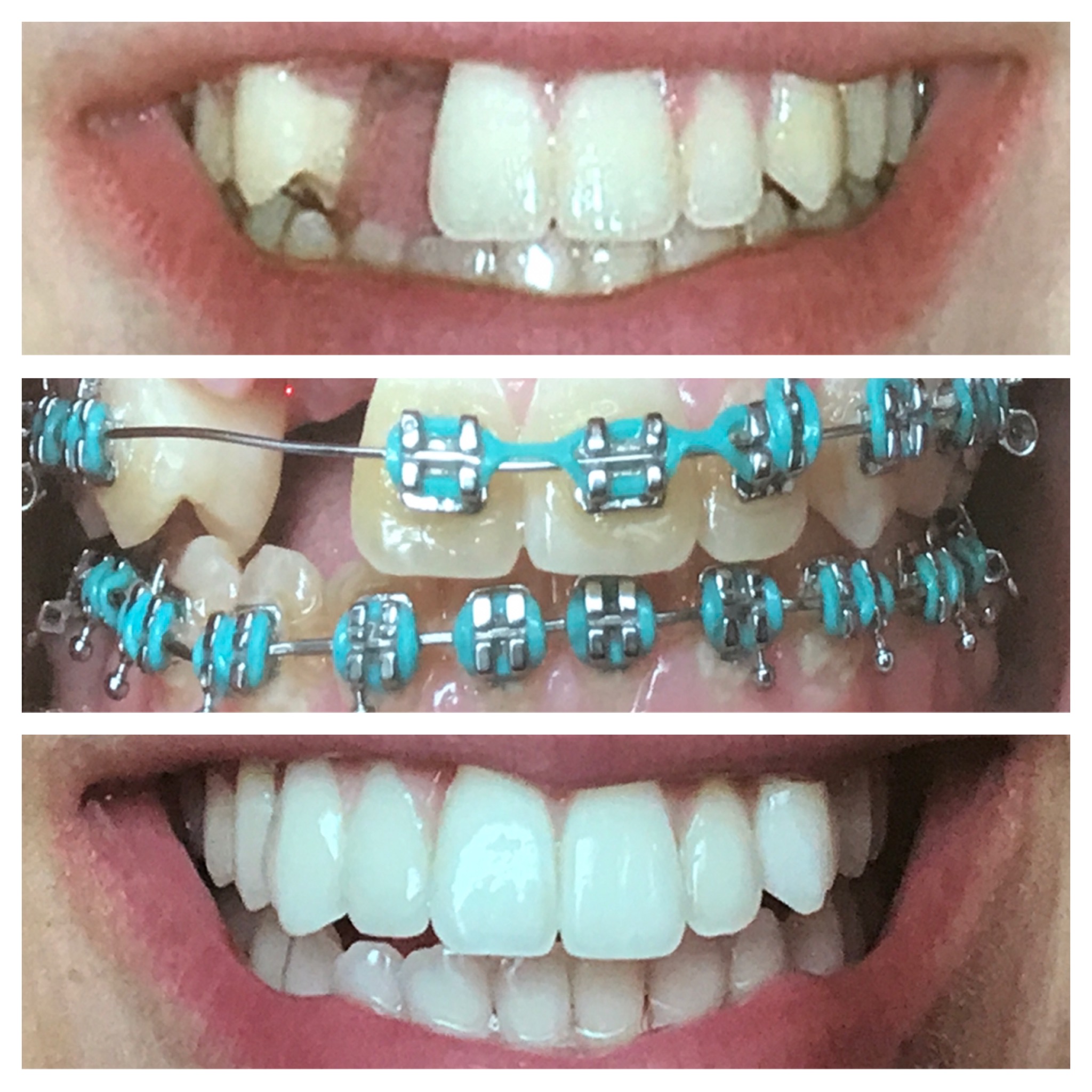 Kieferorthopädische Behandlung zur Begradigung aller Zähne.