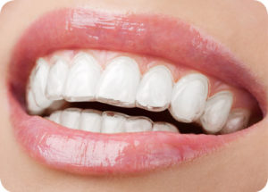 Aligner für eine nahezu unsichtbare Zahnkorrektur.