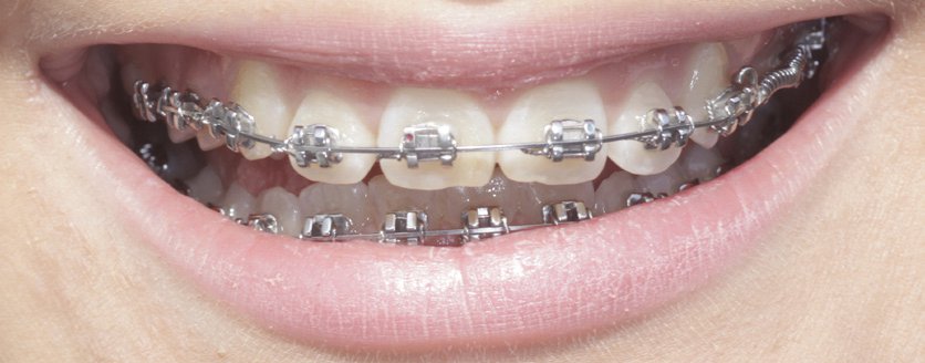 Damon Brackets bei fester Zahnspange: schonende und schnelle Behandlung