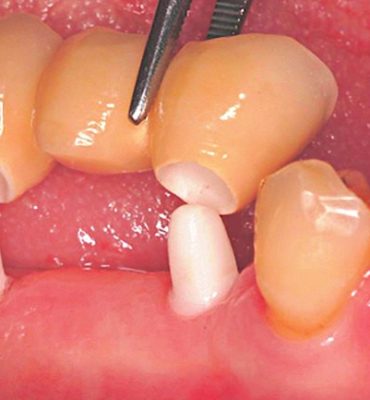 cd2d361f2c Keramikimplantate im kaufunktionellen Seitenzahngebiet.