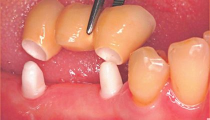 Keramikimplantate im kaufunktionellen Seitenzahngebiet.