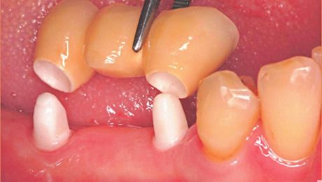 Keramikimplantate im kaufunktionellen Seitenzahngebiet.