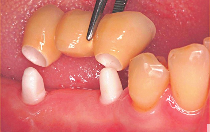 Keramikimplantate im kaufunktionellen Seitenzahngebiet.