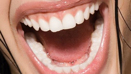 Strahlendes Lächeln Implantaten oder Wurzelbehandlung.