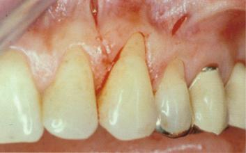Bei der Behandlung von Parodontose entfernen wir das obere Zahnfleischgewebe um den parodontalen Defekt behandeln zu können.