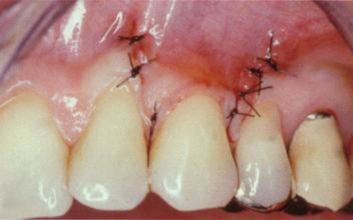 Am Ende der Behanldung von Parodontose wird die geöffnete Stelle im Zahnfleisch sorgfältig zugenäht und eine Salbe zur optimalen Wundheilung aufgetragen.