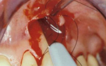 Chirurgischer Eingriff bei parodontologischer Behandlung
