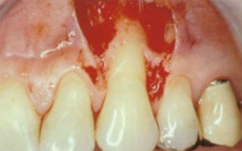 Parodontologie: Entfernung von Zahnstein und Plaque auf der Wurzeloberfläche