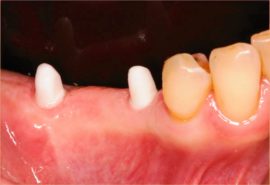 Zähne vor der Behandlung mit Implantat-gestütztem Zahnersatz.