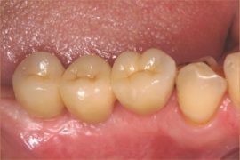 Das Ergebnis von Implantat-gestütztem Zahnersatz von ALL DENTE.Das Ergebnis von implantatgestütztem Zahnersatz von ALL DENTE.