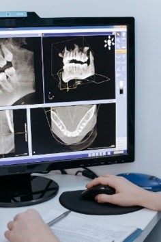 Bei der CEREC-Behandlung wird mithilfe eines Computerprogrammes der Zahnersatz digital erstellt.