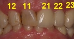 Entzündetes Zahnfleisch und verfärbte Zähne vor der Behandlung mit dem CEREC-Verfahren.