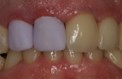 Rekonstruierte Zähne mit dem CEREC-Verfahren.