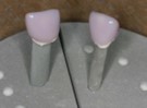 Zwei Zähne, die mittels CEREC-Verfahren konstruiert wurden.