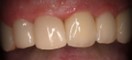 Nachher-Bild der Zähne nach der Behandlung mit dem CEREC-Verfahren.