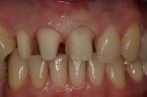 Die Zähne werden währende der CEREC-Behandlung zu Stumpfen gekürzt.