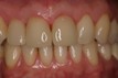 Nachher-Foto der Zähne nach der Behandlung mit dem CEREC-Verfahren.