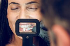 Beim Einsetzen von Veneers wird die Farbe der Verblendschale an Ihre Zähne angepasst.