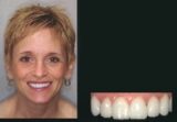 Erfolgreich behandelte Zähne mit einer Keramikkrone nach dem CEREC-Verfahren.